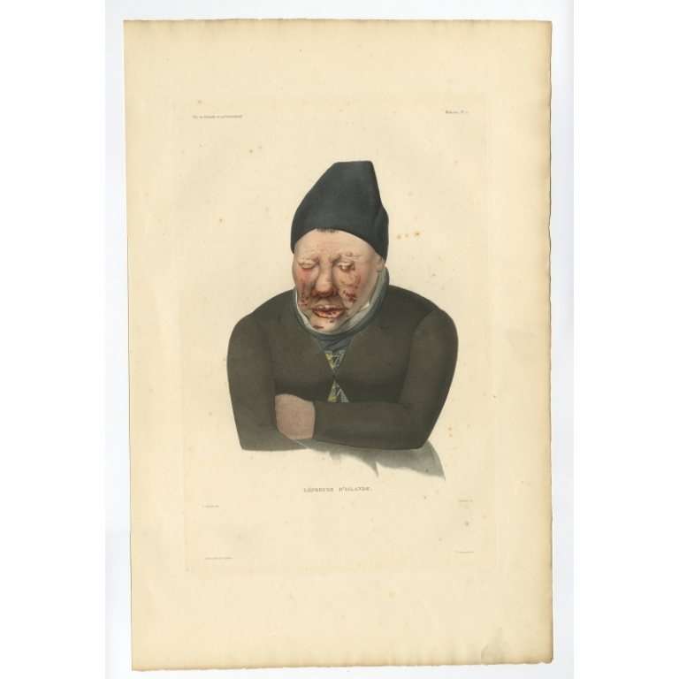 Pl.2 Antique Print of a Leper from Iceland by Gaimard (1842)