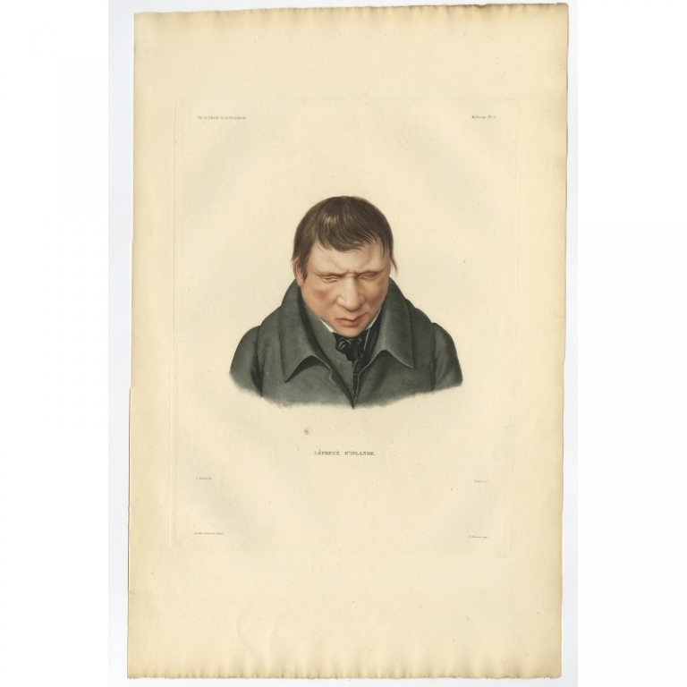 Pl.7 Antique Print of a Leper from Iceland by Gaimard (1842)