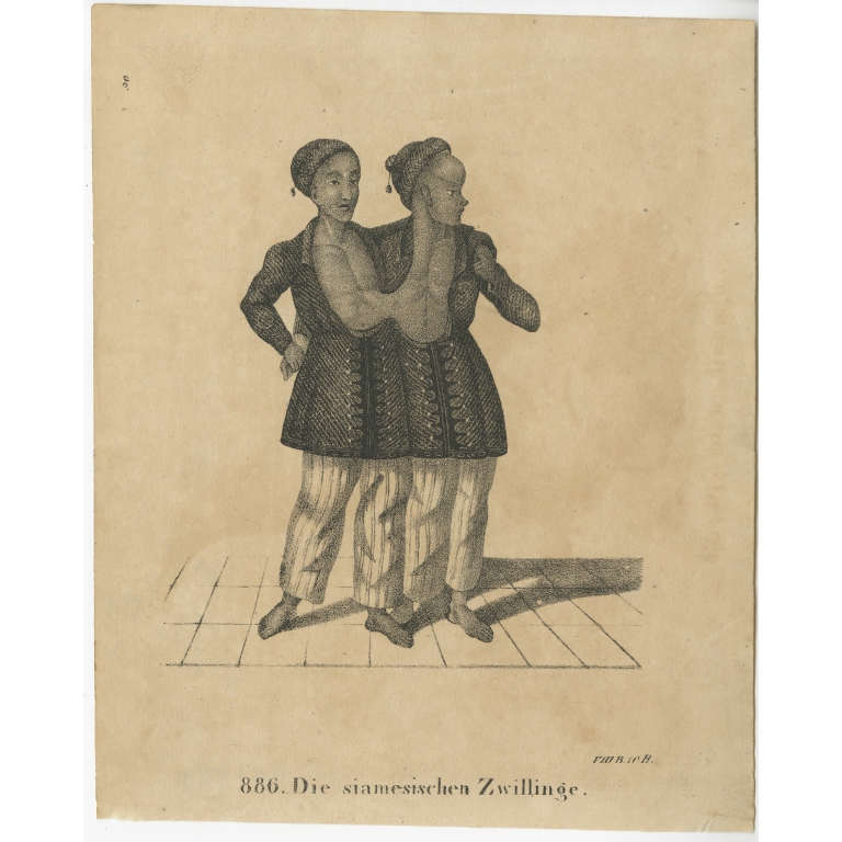 Antique Print of Conjoined Twins (c.1860)